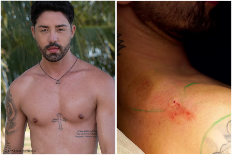 Rico Melquiades exibe procedimento perigoso nas pernas e levanta alerta médico sobre perigos do PMMA